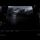 Calcification in patellar ligament, infrapatellar bursa: US - Ultrasound
